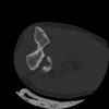 SPORK, NICO - 22.03.1976 - 02.08.2022 - CT obere Extremität - 17:51:17